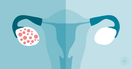 Living with PCOS: Understanding and Managing Polycystic Ovary Syndrome